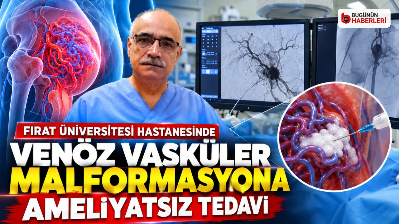 Fırat Üniversitesi Hastanesinde venöz vasküler malformasyona ameliyatsız köpüklü tedavi